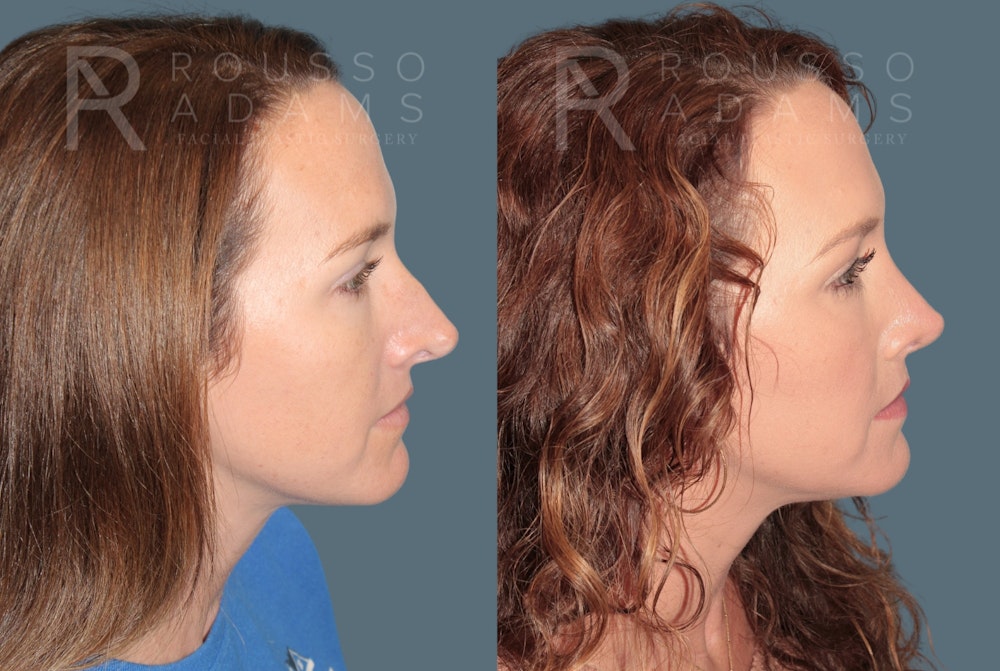 Revision rhinoplasty before and after, side profile, patient two