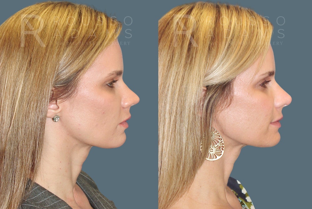Rhinoplasty before and after, side profile, patient four
