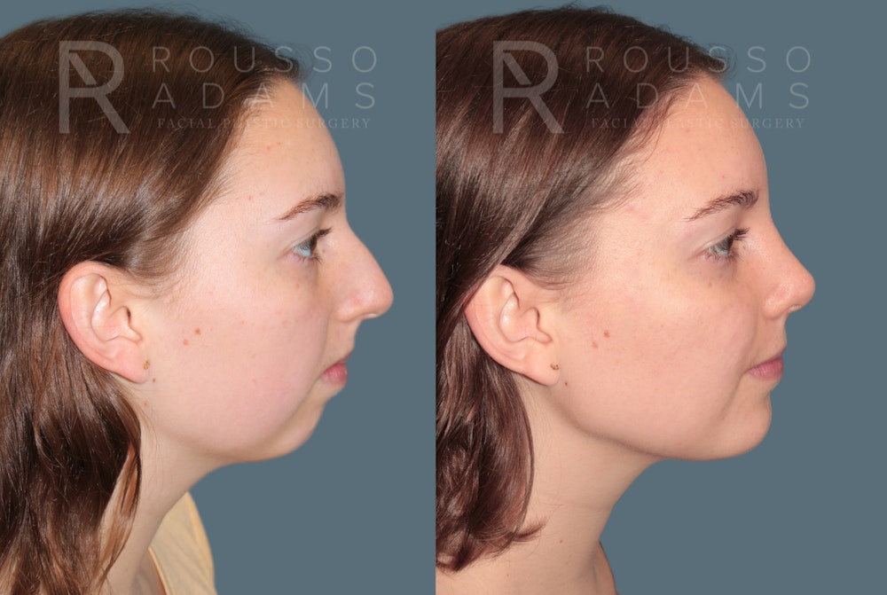 Rhinoplasty before and after, side profile, patient one