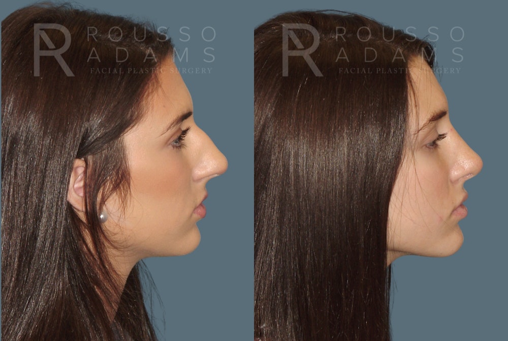 Rhinoplasty before and after, side profile, patient three